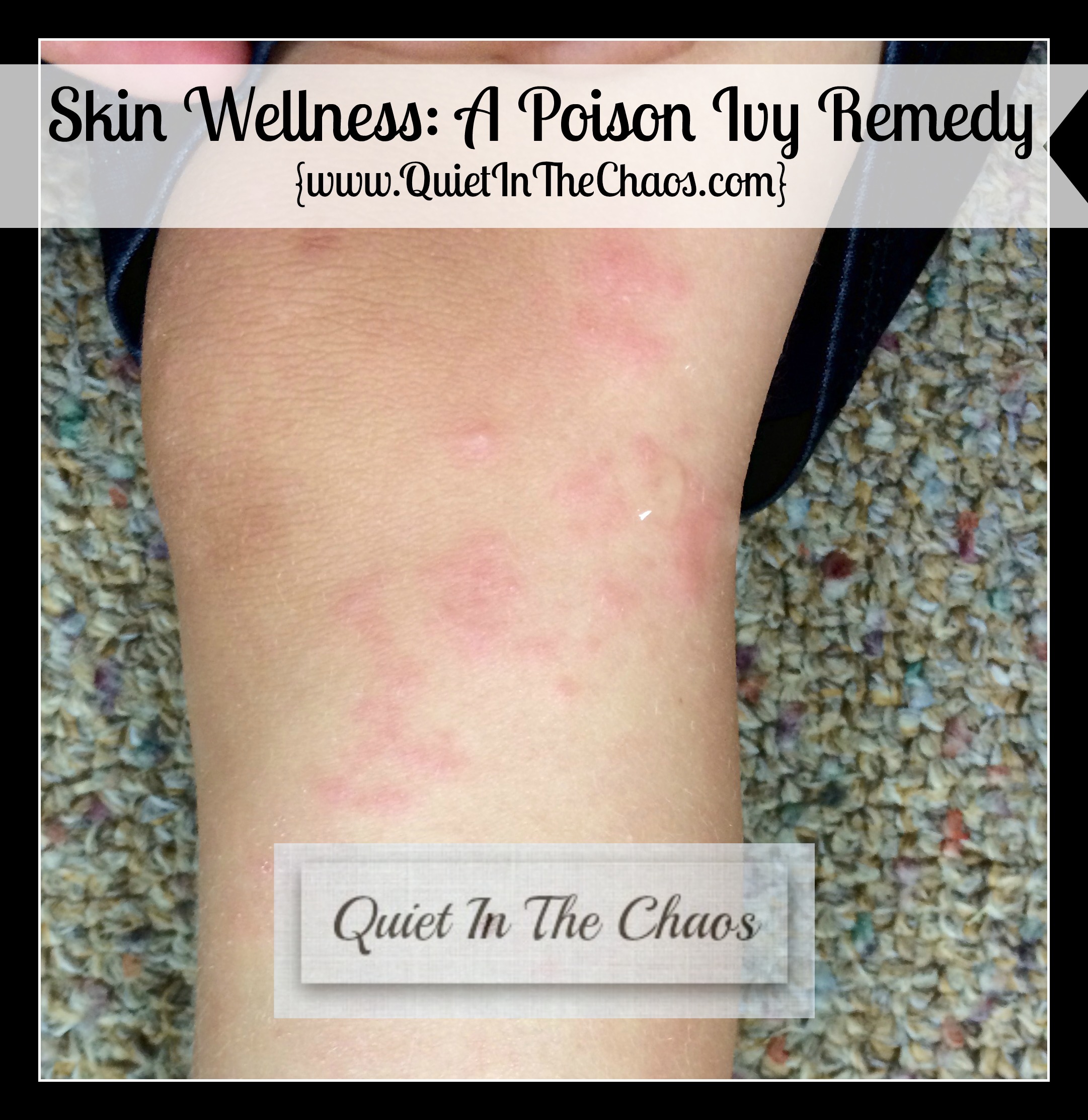 Skin Wellness A Poison Ivy Remedy {www.QuietInTheChaos.com}