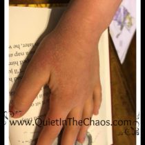 Eczema Before